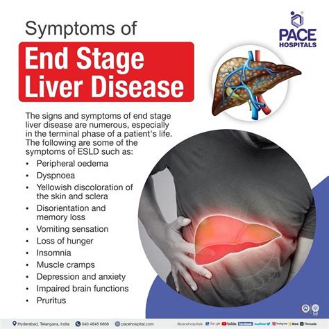 End stage liver cancer: Symptoms timeline and life .